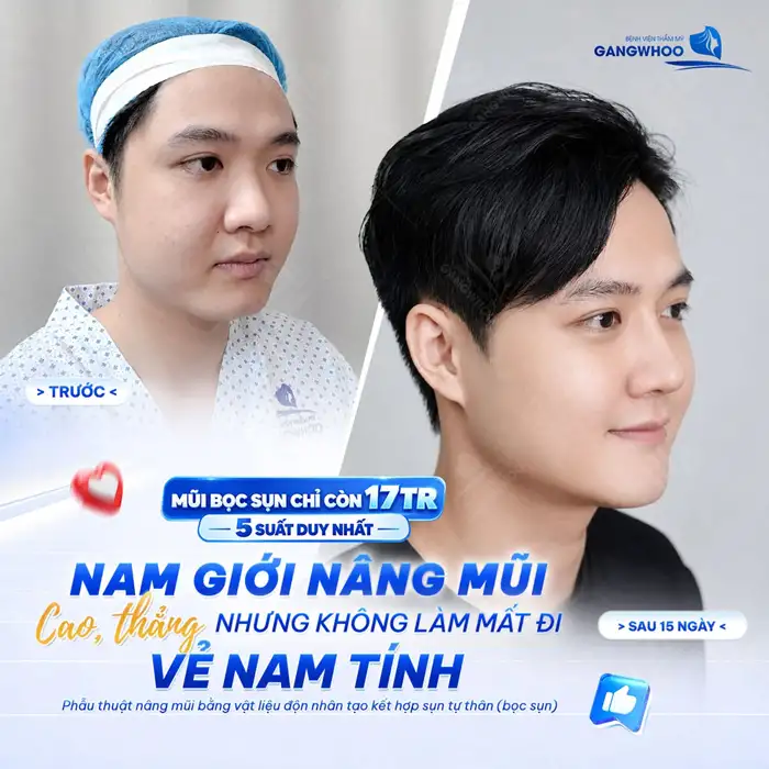 Nâng mũi bao lâu thì hết căng tức?