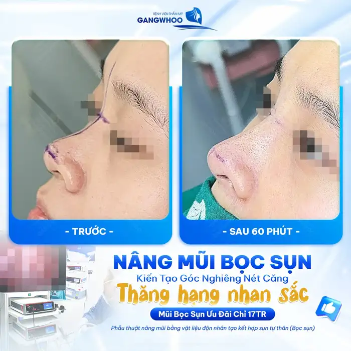 Nâng mũi Surgiform có vĩnh viễn không?