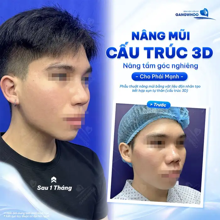 Nâng mũi Surgiform