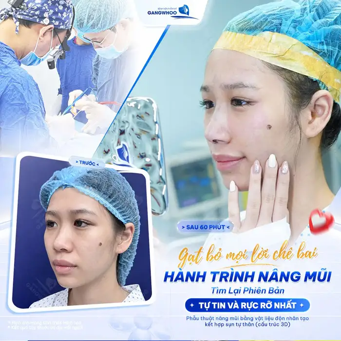 Nâng mũi Surgiform có vĩnh viễn không?