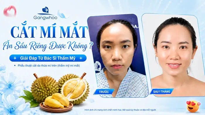 Cắt Mí Mắt Ăn Sầu Riêng Được Không? Những Điều Bác Sĩ Khuyên Bạn