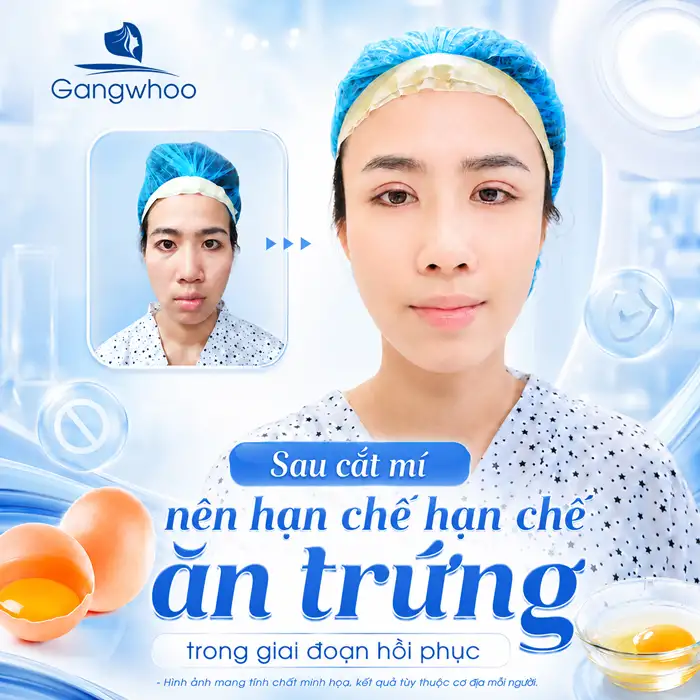 Cắt Mí Mắt Ăn Sầu Riêng Được Không? Những Điều Bác Sĩ Khuyên Bạn