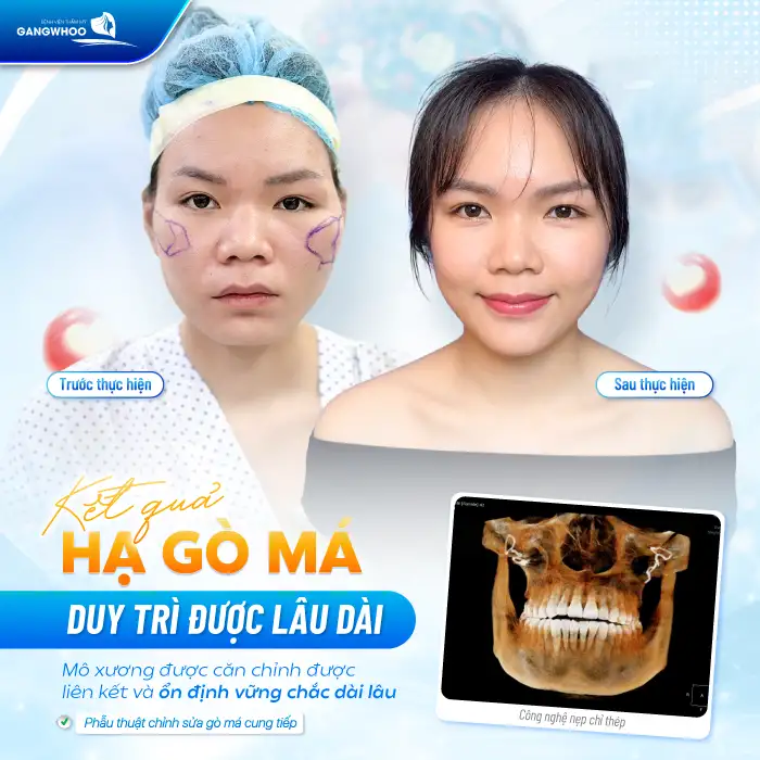 Hạ Gò Má Có Được Vĩnh Viễn Không? Bác Sĩ Chuyên Khoa Chia Sẻ