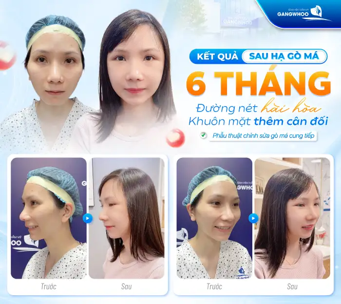 Hạ Gò Má Có Được Vĩnh Viễn Không? Bác Sĩ Chuyên Khoa Chia Sẻ