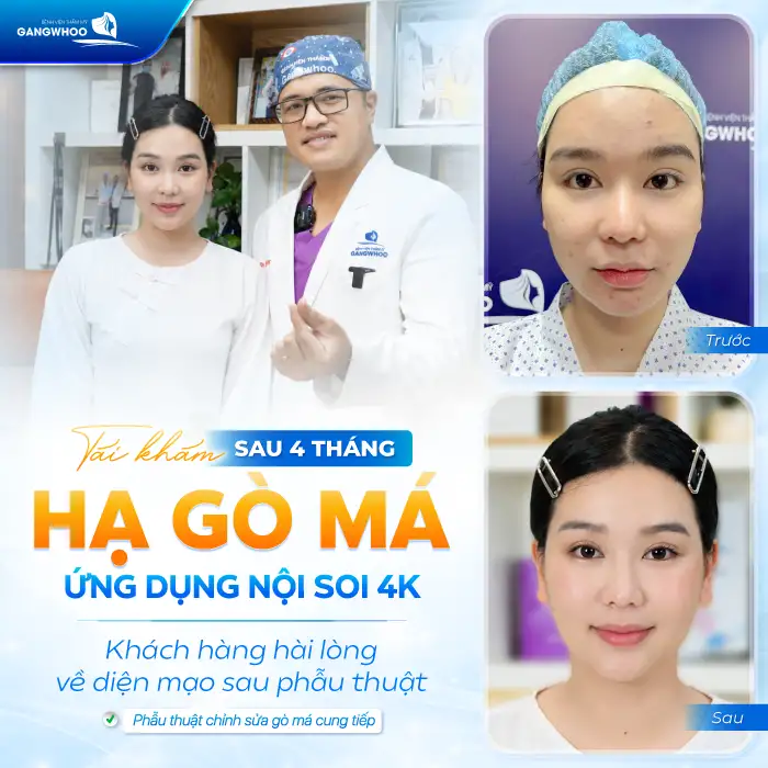 Hạ Gò Má Có Được Vĩnh Viễn Không? Bác Sĩ Chuyên Khoa Chia Sẻ