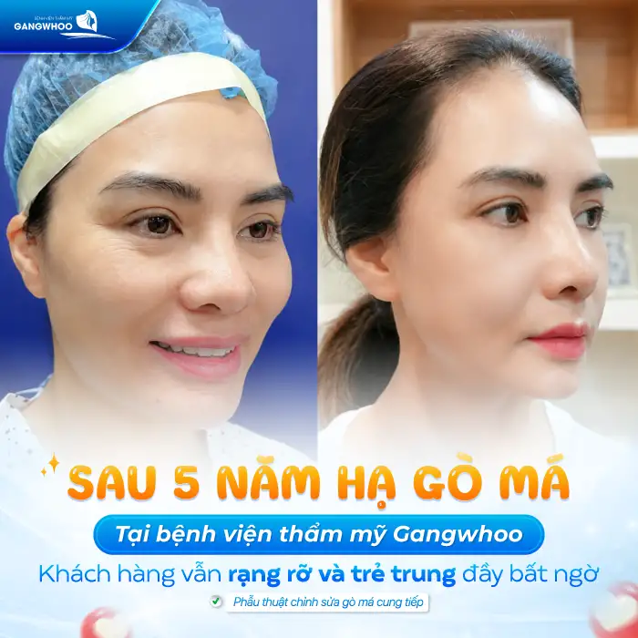Hạ Gò Má Có Được Vĩnh Viễn Không? Bác Sĩ Chuyên Khoa Chia Sẻ