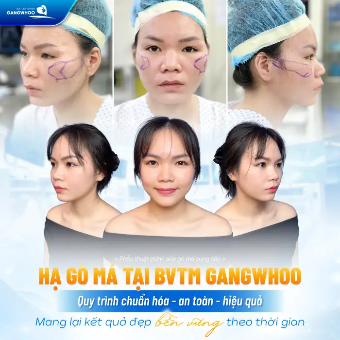 Hạ Gò Má Có Được Vĩnh Viễn Không? Bác Sĩ Chuyên Khoa Chia Sẻ