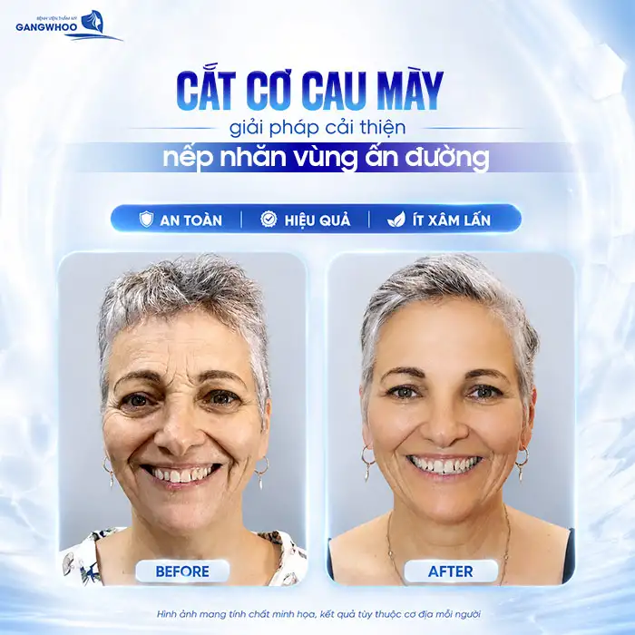 Cắt Cơ Cau Mày Giá Bao Nhiêu? Cập Nhật Bảng Giá Mới 2026