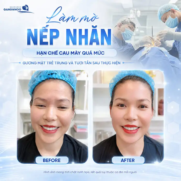 Cắt Cơ Cau Mày Giá Bao Nhiêu? Cập Nhật Bảng Giá Mới 2026