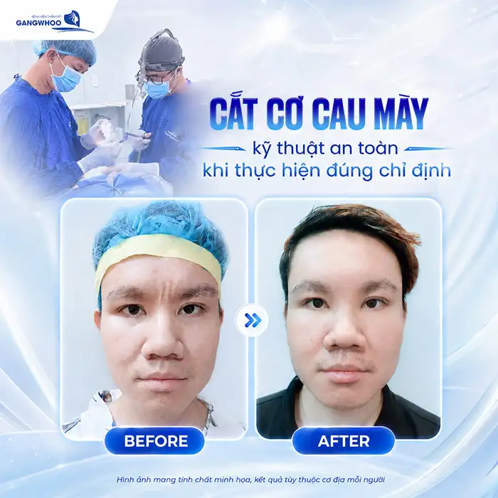 Cắt Cơ Cau Mày Giá Bao Nhiêu? Cập Nhật Bảng Giá Mới 2026