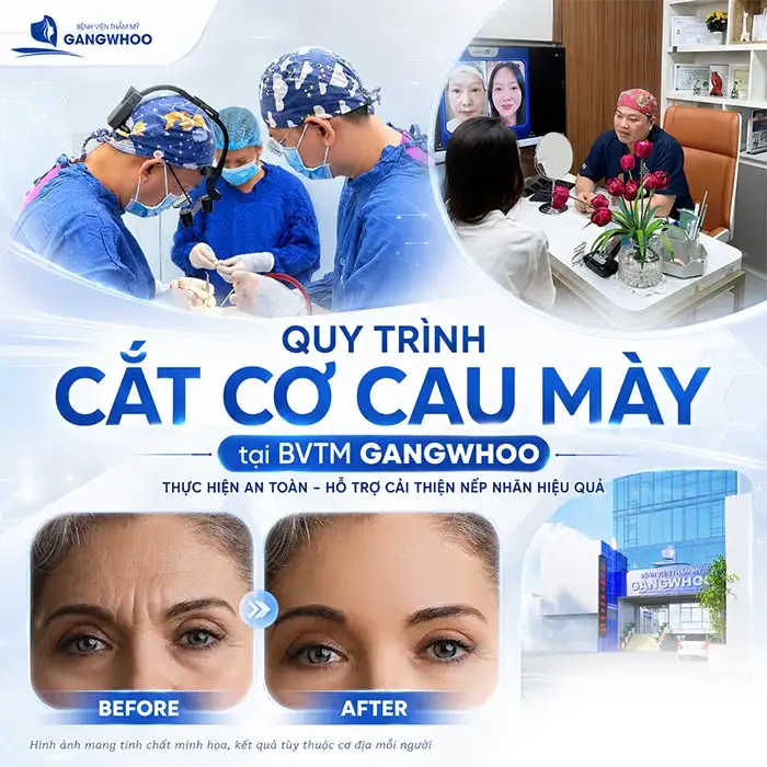 Cắt Cơ Cau Mày Giá Bao Nhiêu? Cập Nhật Bảng Giá Mới 2026