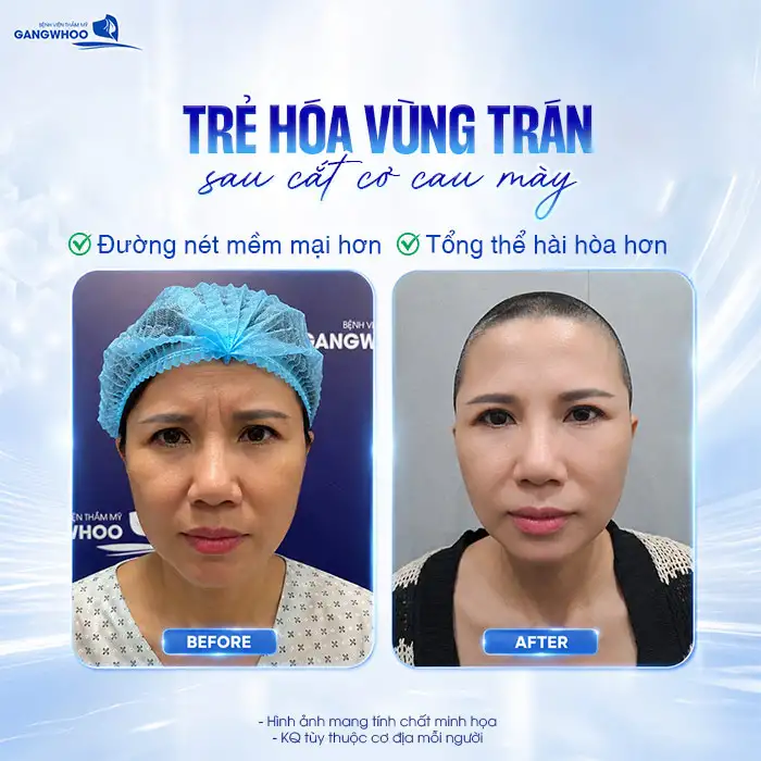 Cắt Cơ Cau Mày Giá Bao Nhiêu? Cập Nhật Bảng Giá Mới 2026