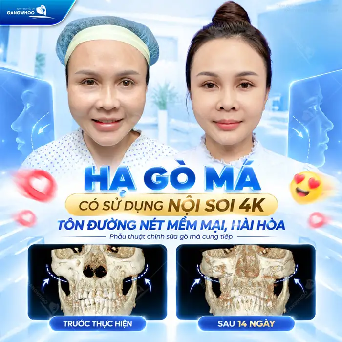 Hạ Gò Má Có Được Vĩnh Viễn Không? Bác Sĩ Chuyên Khoa Chia Sẻ