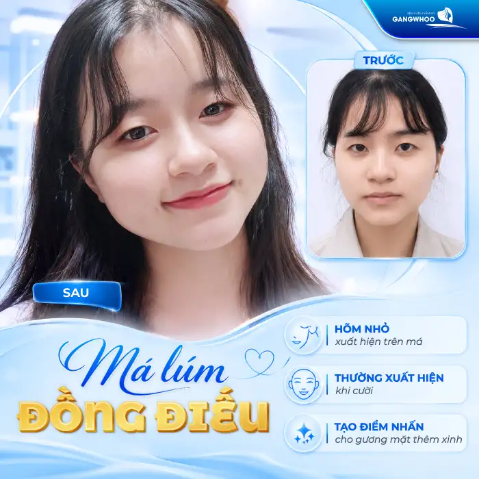 Má Lúm Đồng Điếu Là Gì? Ý Nghĩa, Cách Tạo Má Lúm Đẹp Tự Nhiên