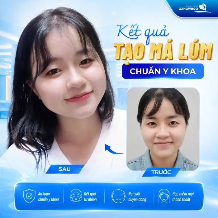 Má Lúm Đồng Điếu Là Gì? Ý Nghĩa, Cách Tạo Má Lúm Đẹp Tự Nhiên