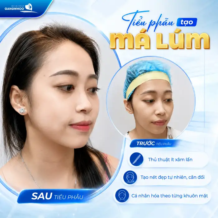 Má Lúm Đồng Điếu Là Gì? Ý Nghĩa, Cách Tạo Má Lúm Đẹp Tự Nhiên
