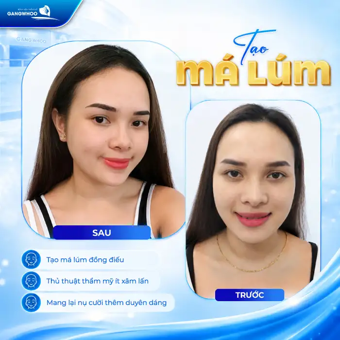 Má Lúm Đồng Điếu Là Gì? Ý Nghĩa, Cách Tạo Má Lúm Đẹp Tự Nhiên