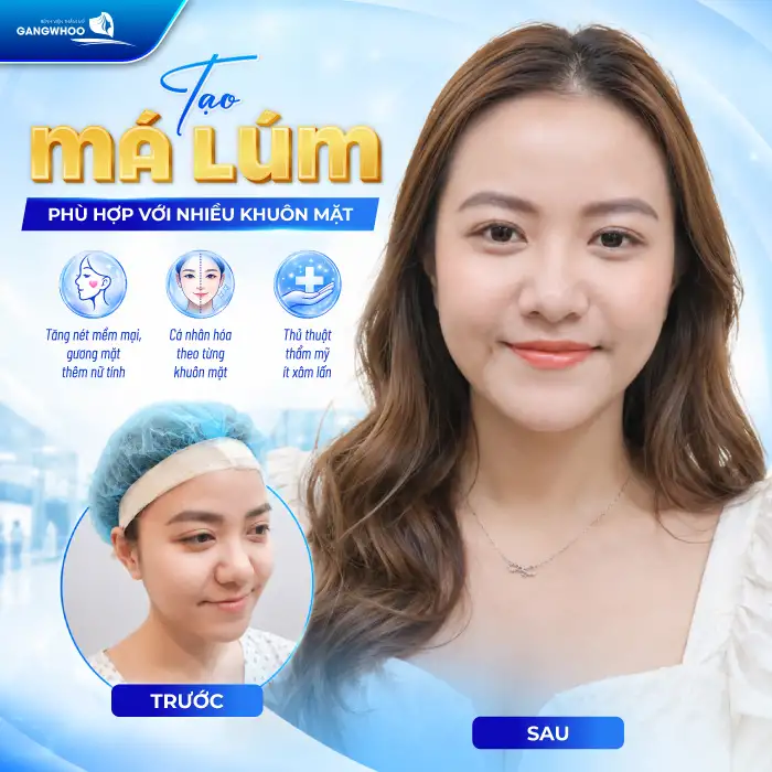 Má Lúm Đồng Điếu Là Gì? Ý Nghĩa, Cách Tạo Má Lúm Đẹp Tự Nhiên