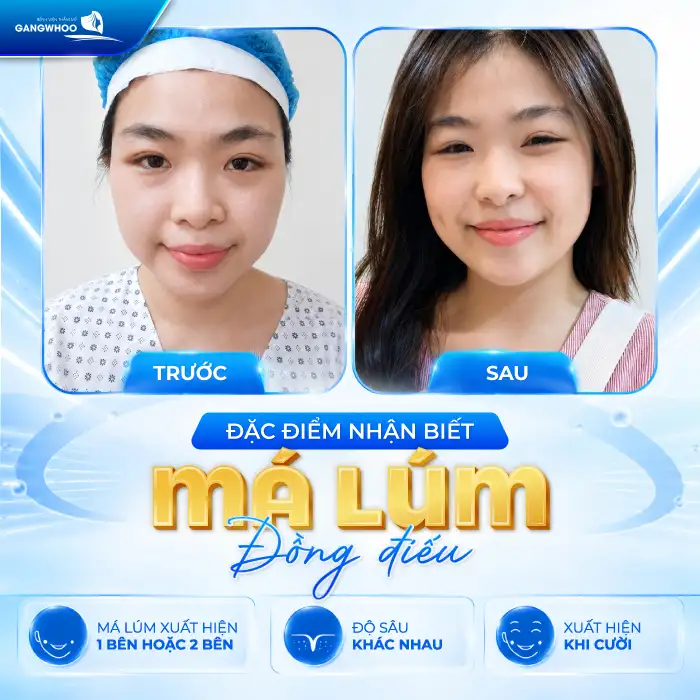Má Lúm Đồng Điếu Là Gì? Ý Nghĩa, Cách Tạo Má Lúm Đẹp Tự Nhiên