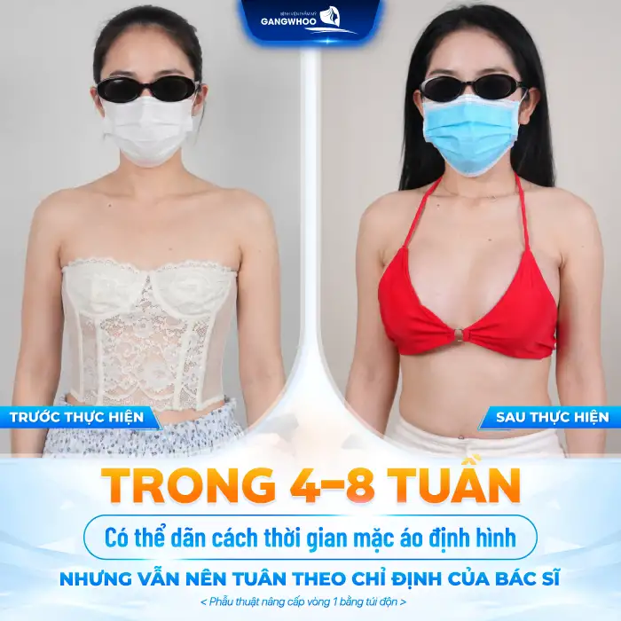 Nâng Ngực Bao Lâu Được Thả Rông? Bác Sĩ Giải Đáp Thời Điểm An Toàn