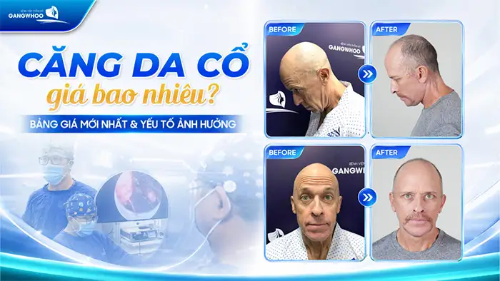Căng Da Cổ Giá Bao Nhiêu? Bảng Giá Mới Nhất & Yếu Tố Ảnh Hưởng