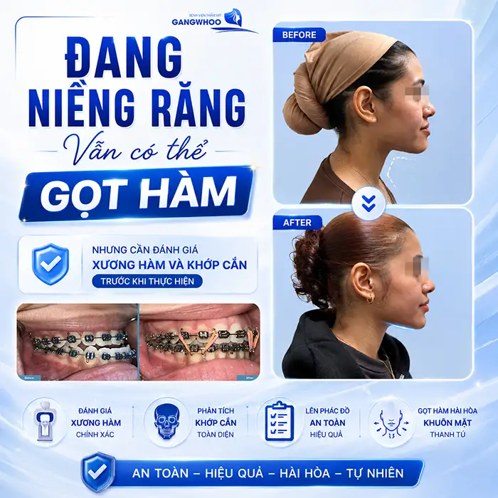 Đang Niềng Răng Có Gọt Hàm Được Không? Những Điều Cần Lưu ý