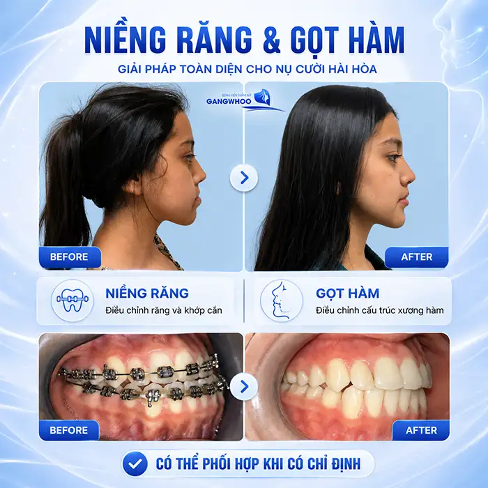 Đang Niềng Răng Có Gọt Hàm Được Không? Những Điều Cần Lưu ý