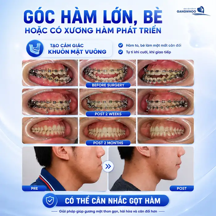 Đang Niềng Răng Có Gọt Hàm Được Không? Những Điều Cần Lưu ý