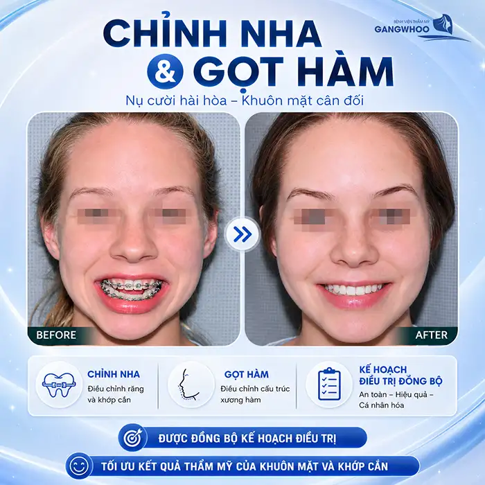 Đang Niềng Răng Có Gọt Hàm Được Không? Những Điều Cần Lưu ý