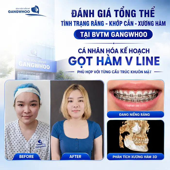 Đang Niềng Răng Có Gọt Hàm Được Không? Những Điều Cần Lưu ý