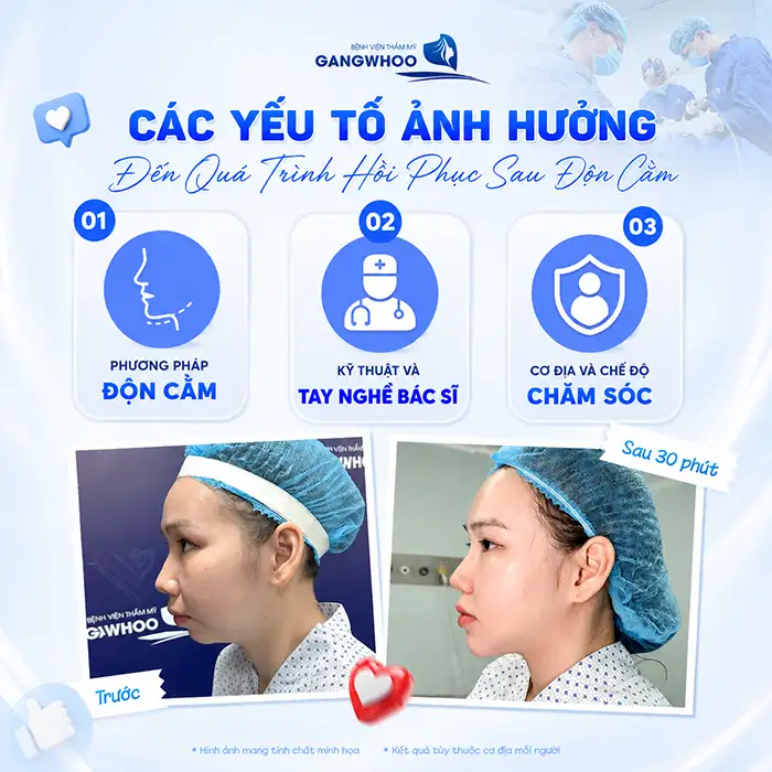 Độn Cằm Bao Lâu Cười Được? Lời Khuyên Từ Bác Sĩ Để Hồi Phục Nhanh Và An Toàn