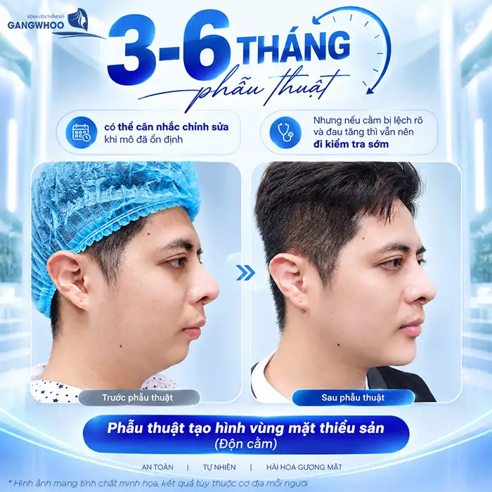 Độn Cằm Bị Lệch Phải Làm Sao? Nguyên Nhân Và Cách Khắc Phục