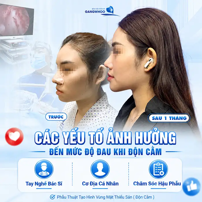 Độn Cằm Có Đau Không? Giải Đáp Chi Tiết Từ A-Z
