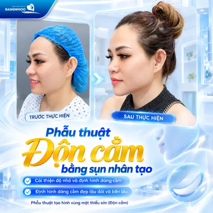 Độn Cằm Có Được Vĩnh Viễn Không? Giải Đáp Chi Tiết Từ Chuyên Gia