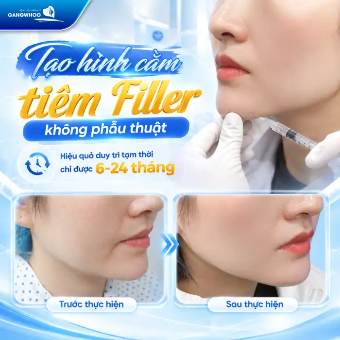 Độn Cằm Có Được Vĩnh Viễn Không? Giải Đáp Chi Tiết Từ Chuyên Gia
