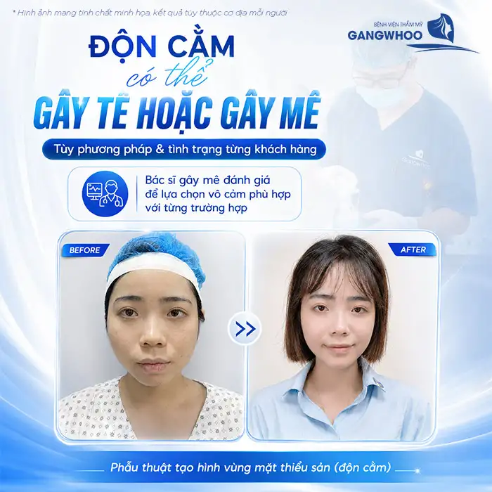 Độn Cằm Có Gây Mê Không? Giải Đáp Từ Bác Sĩ Chuyên Khoa
