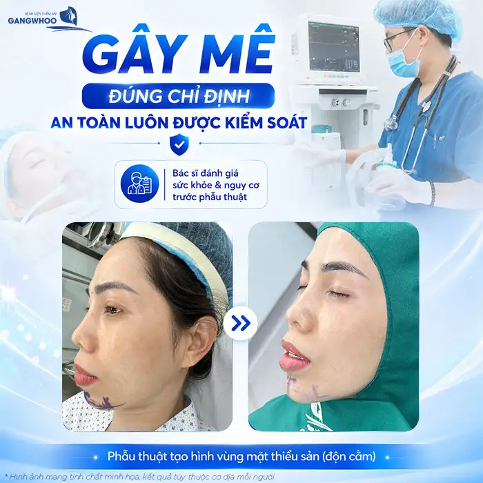 Độn Cằm Có Gây Mê Không? Giải Đáp Từ Bác Sĩ Chuyên Khoa