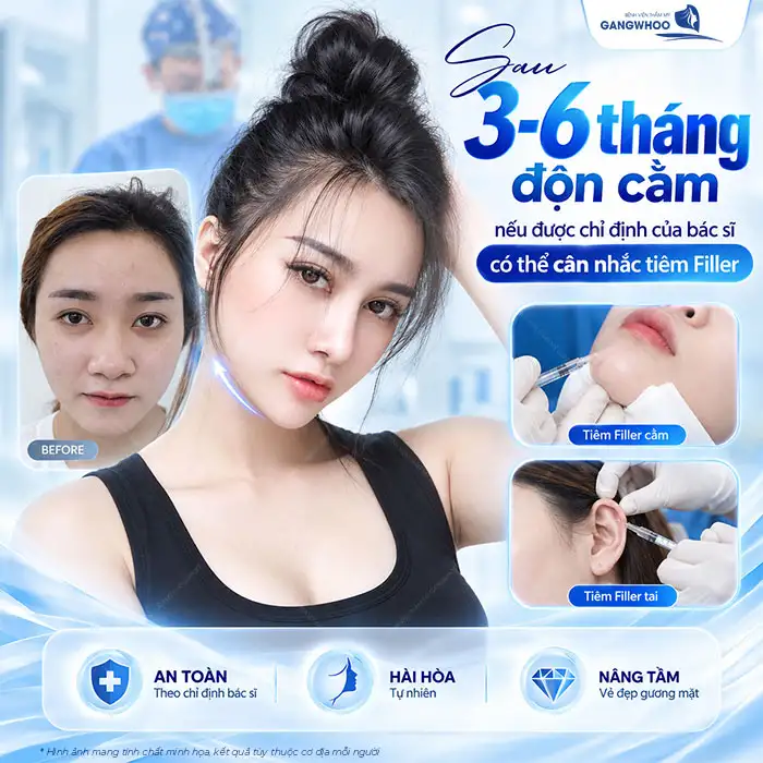 Độn Cằm Rồi Có Tiêm Filler Được Không? Bác Sĩ Giải Đáp