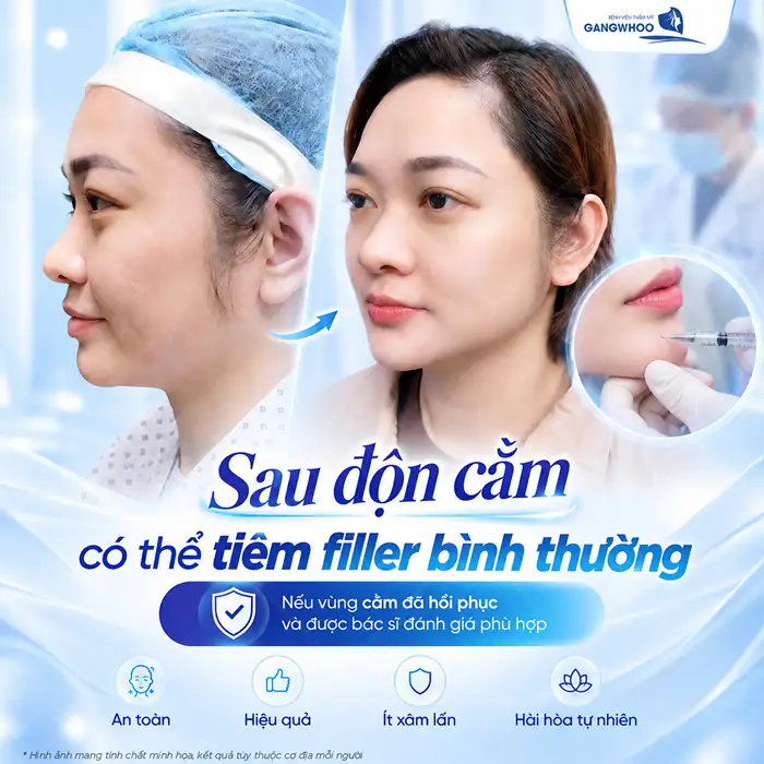 Độn Cằm Rồi Có Tiêm Filler Được Không? Bác Sĩ Giải Đáp