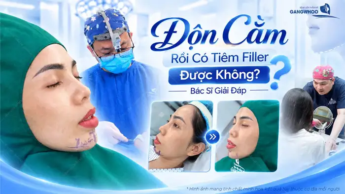 Độn Cằm Rồi Có Tiêm Filler Được Không? Bác Sĩ Giải Đáp