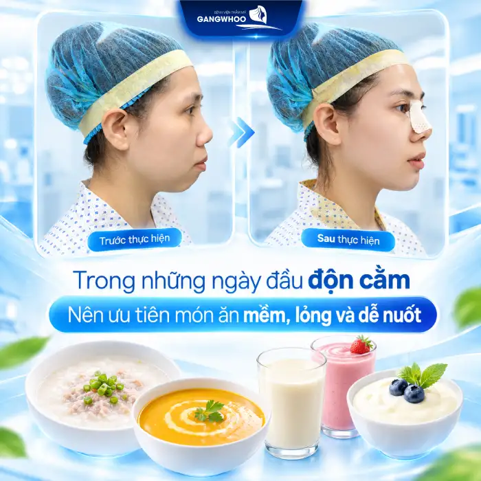 Độn Cằm Kiêng Ăn Gì? Top 7 Thực Phẩm Cần Tránh