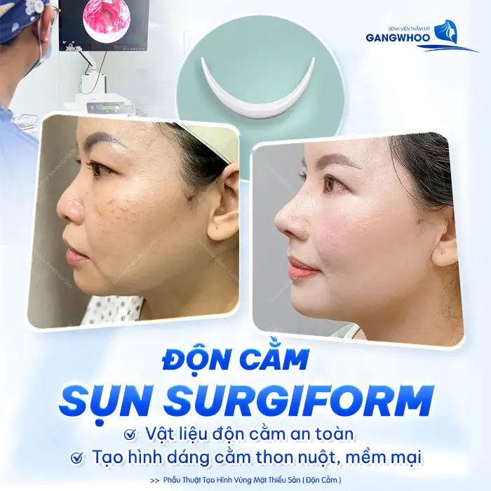 Độn Cằm Surgiform: Giải Pháp Tối Ưu Cho Gương Mặt V-line Hoàn Hảo