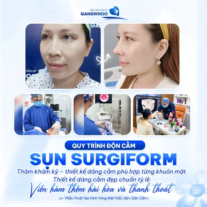 Độn Cằm Surgiform: Giải Pháp Tối Ưu Cho Gương Mặt V-line Hoàn Hảo