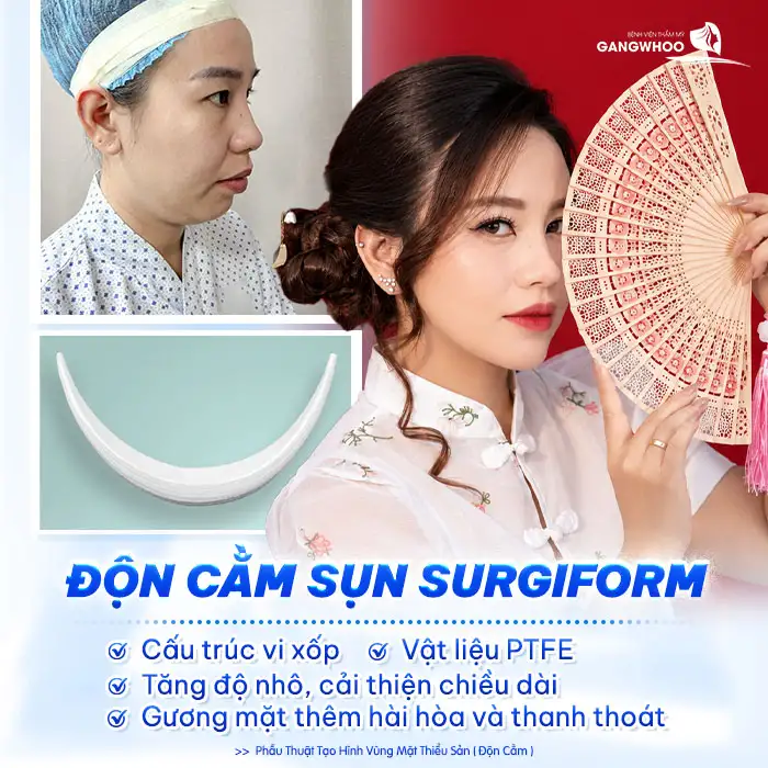 Độn Cằm Surgiform: Giải Pháp Tối Ưu Cho Gương Mặt V-line Hoàn Hảo
