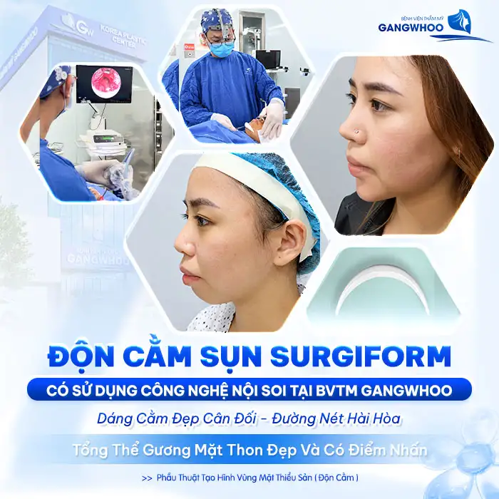 Độn Cằm Surgiform: Giải Pháp Tối Ưu Cho Gương Mặt V-line Hoàn Hảo