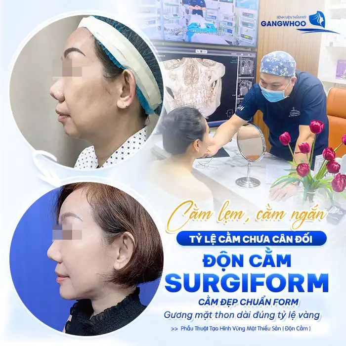 Độn Cằm Surgiform: Giải Pháp Tối Ưu Cho Gương Mặt V-line Hoàn Hảo