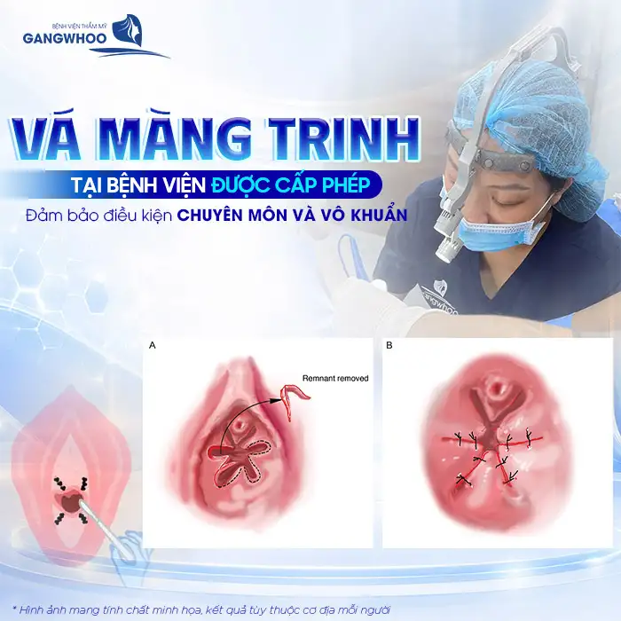 Vá Màng Trinh Có Nguy Hiểm Không? Bác Sĩ Bệnh Viện Gangwhoo Chia Sẻ