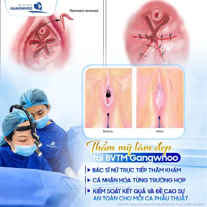 Vá Màng Trinh Được Không Khi Đã Quan Hệ Nhiều Lần? Giải Đáp Từ Bác Sĩ