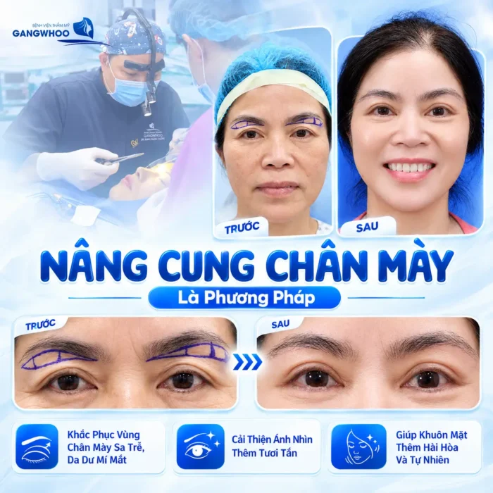 Nâng Cung Chân Mày Giữ Được Bao Lâu? Giải Đáp Chuyên Sâu Từ Góc Nhìn Y Khoa