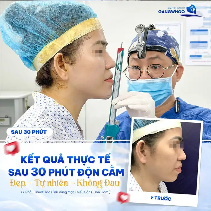Độn Cằm Có Được Vĩnh Viễn Không? Giải Đáp Chi Tiết Từ Chuyên Gia